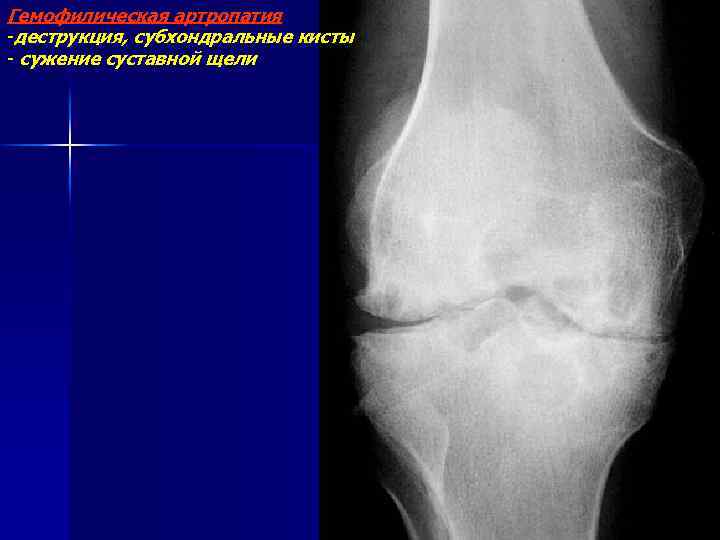 Субхондральные кисты коленного сустава рентген. Деструкция кости бедренной кости рентген. Киста субхондральной кости.