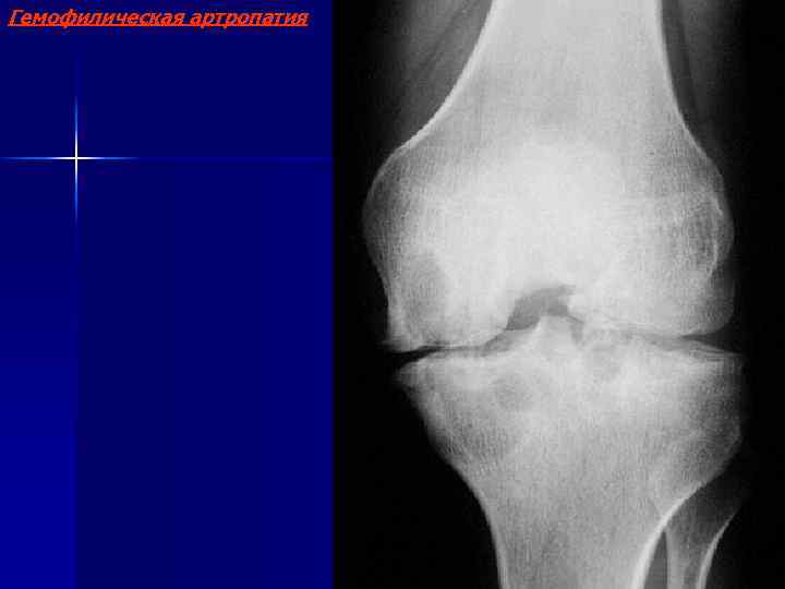 Гемофилическая артропатия 