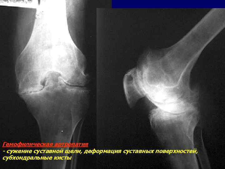 Гемофилическая артропатия - сужение суставной щели, деформация суставных поверхностей, субхондральные кисты 