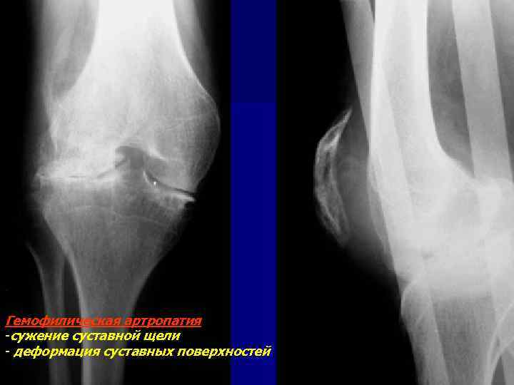 Гемофилическая артропатия -сужение суставной щели - деформация суставных поверхностей 