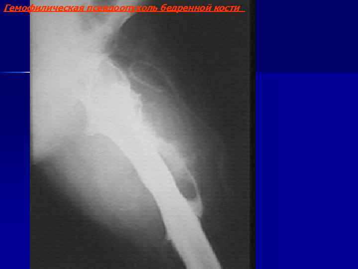 Гемофилическая псевдоопухоль бедренной кости 