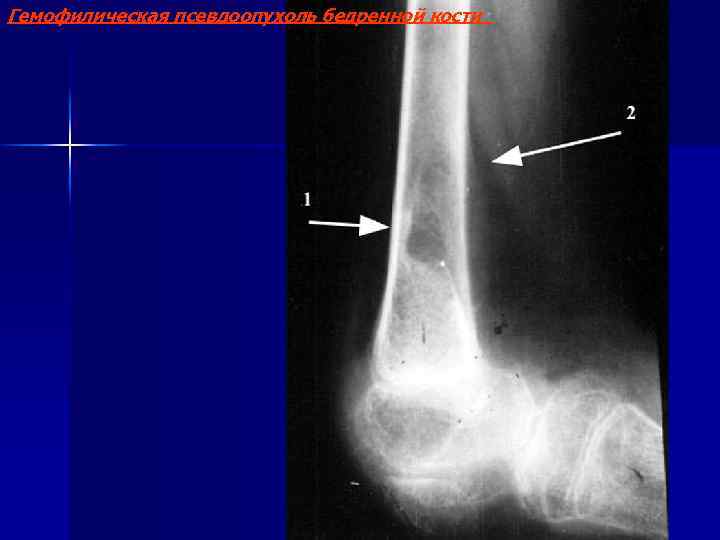 Гемофилическая псевдоопухоль бедренной кости Гемофилия 