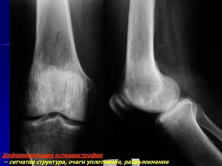 Деформирующая остеодистрофия – сетчатая структура, очаги уплотнения, разволокнение 