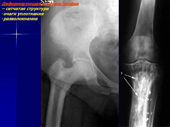 Деформирующая остеодистрофия – сетчатая структура -очаги уплотнения -разволокнение 