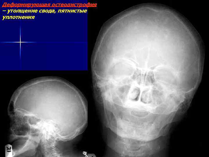Деформирующая остеодистрофия – утолщение свода, пятнистые уплотнения 