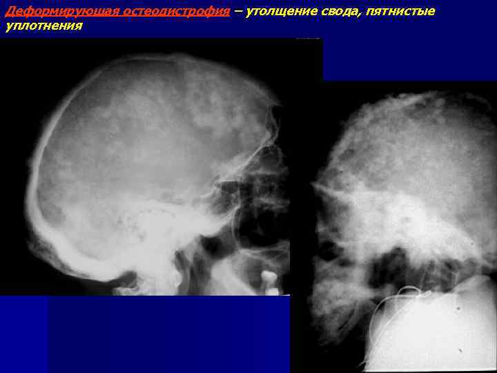 Деформирующая остеодистрофия – утолщение свода, пятнистые уплотнения 