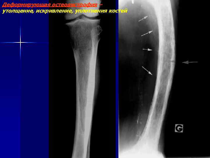 Деформирующая остеодистрофия – утолщение, искривление, уплотнения костей 