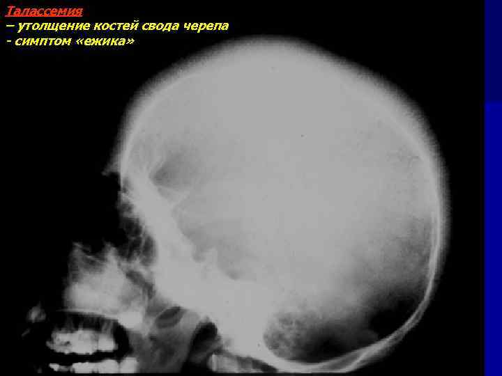 Талассемия – утолщение костей свода черепа - симптом «ежика» 