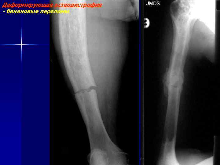 Деформирующая остеодистрофия - банановые переломы 