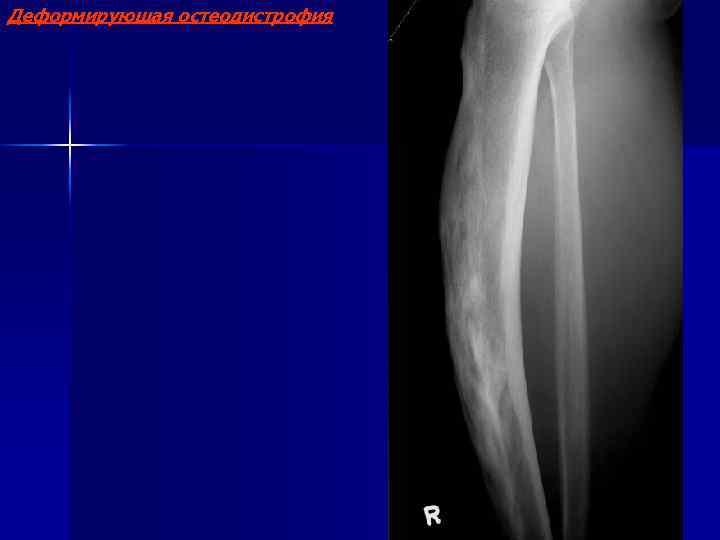 Деформирующая остеодистрофия 