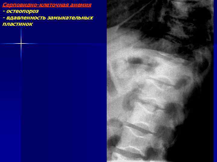 Серповидно-клеточная анемия - остеопороз - вдавленность замыкательных пластинок 
