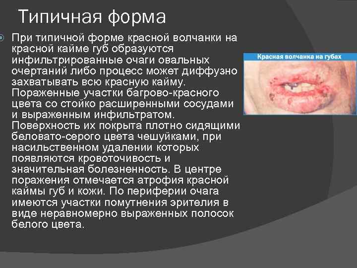  Типичная форма При типичной форме красной волчанки на красной кайме губ образуются инфильтрированные