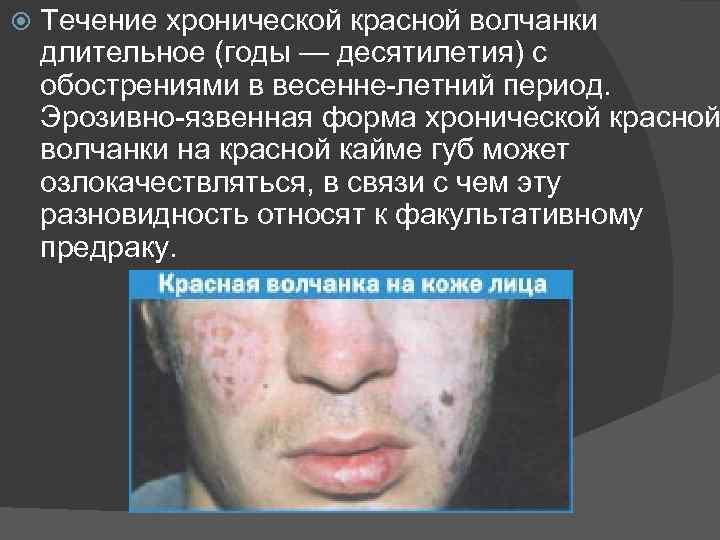  Течение хронической красной волчанки длительное (годы — десятилетия) с обострениями в весенне-летний период.