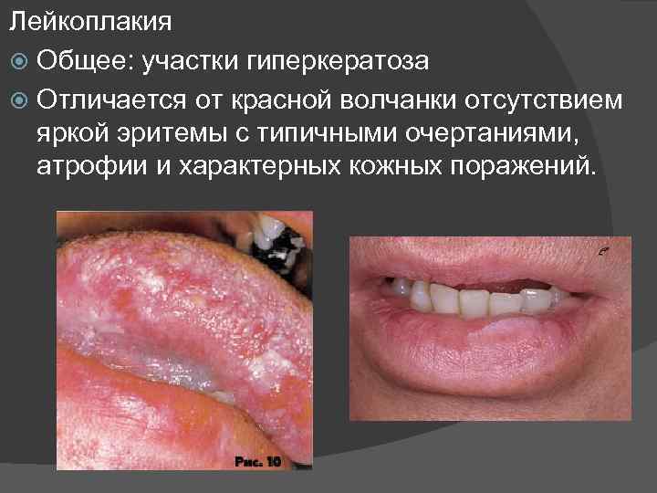 Лейкоплакия Общее: участки гиперкератоза Отличается от красной волчанки отсутствием яркой эритемы с типичными очертаниями,