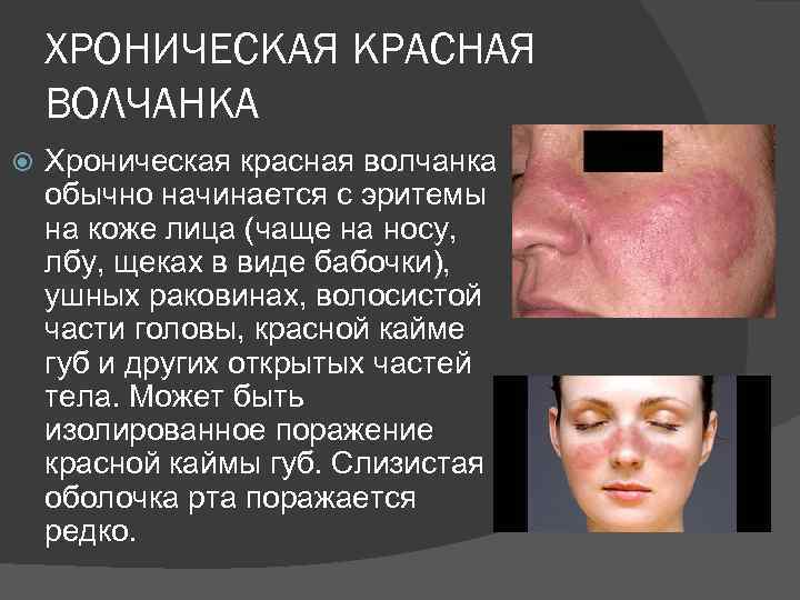 ХРОНИЧЕСКАЯ КРАСНАЯ ВОЛЧАНКА Хроническая красная волчанка обычно начинается с эритемы на коже лица (чаще