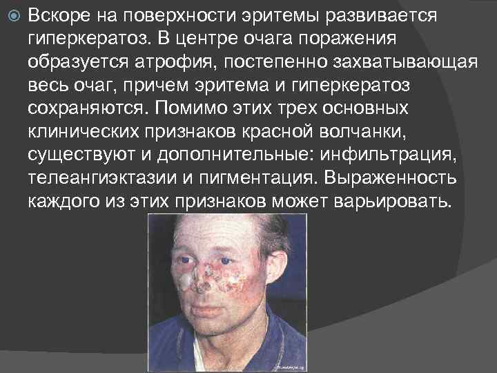  Вскоре на поверхности эритемы развивается гиперкератоз. В центре очага поражения образуется атрофия, постепенно