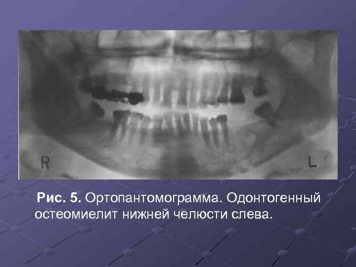 Клиническая картина острого одонтогенного остеомиелита челюсти заключается