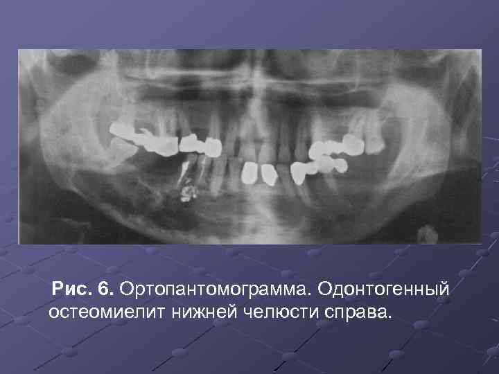 Клиническая картина острого одонтогенного остеомиелита челюсти заключается