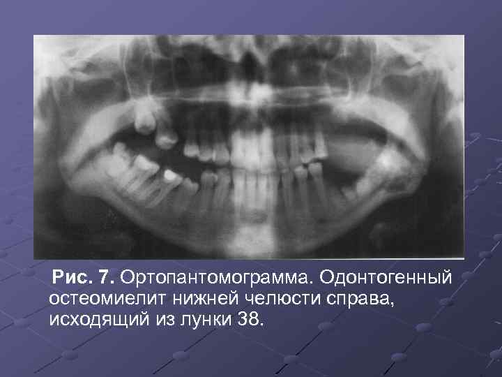 Остеомиелит нижней челюсти мкб