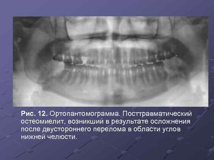 Остеомиелит челюсти симптомы и фото