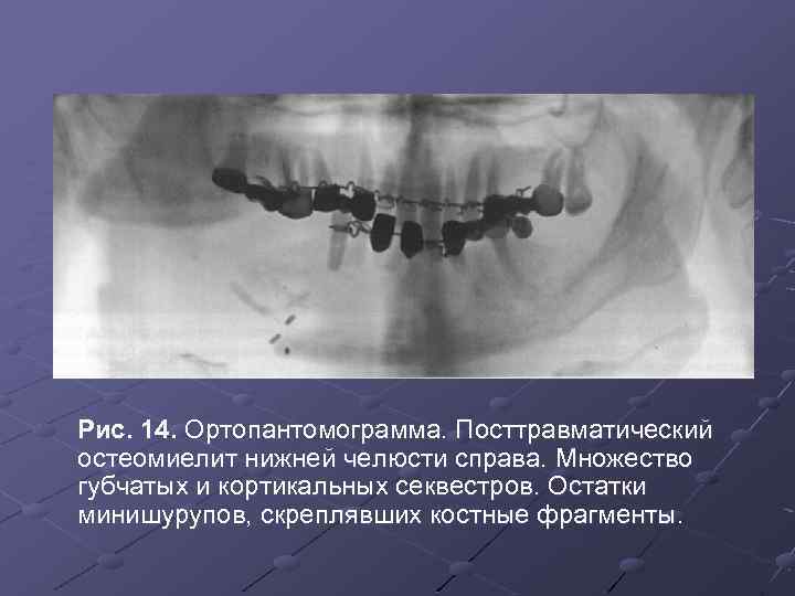 Остеомиелит нижней челюсти фото