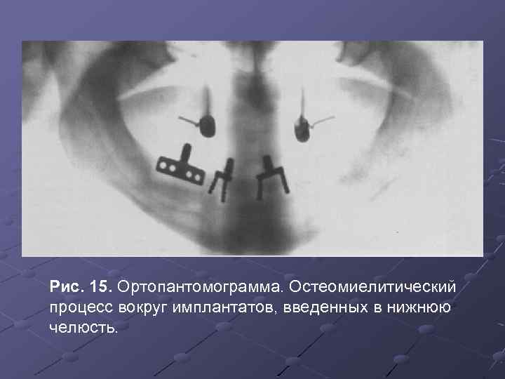 Рис. 15. Ортопантомограмма. Остеомиелитический процесс вокруг имплантатов, введенных в нижнюю челюсть. 