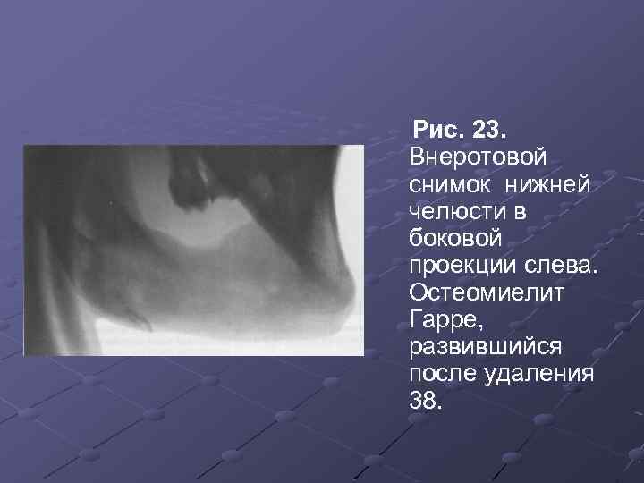 Остеомиелит нижней челюсти мкб