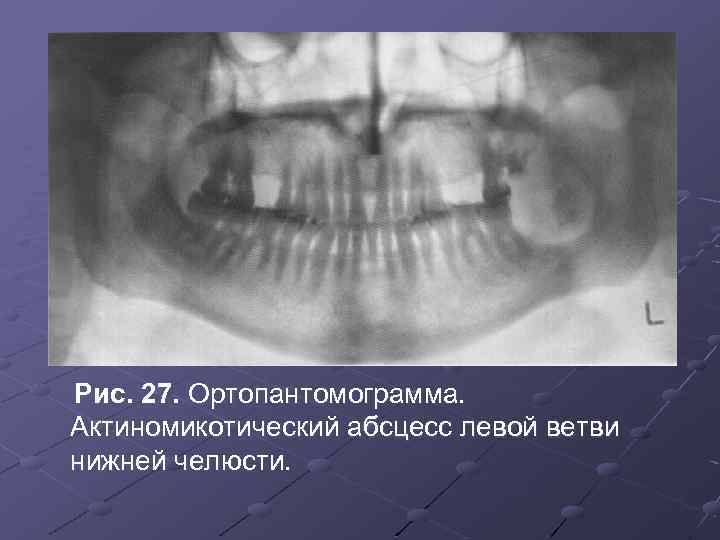 Рис. 27. Ортопантомограмма. Актиномикотический абсцесс левой ветви нижней челюсти. 
