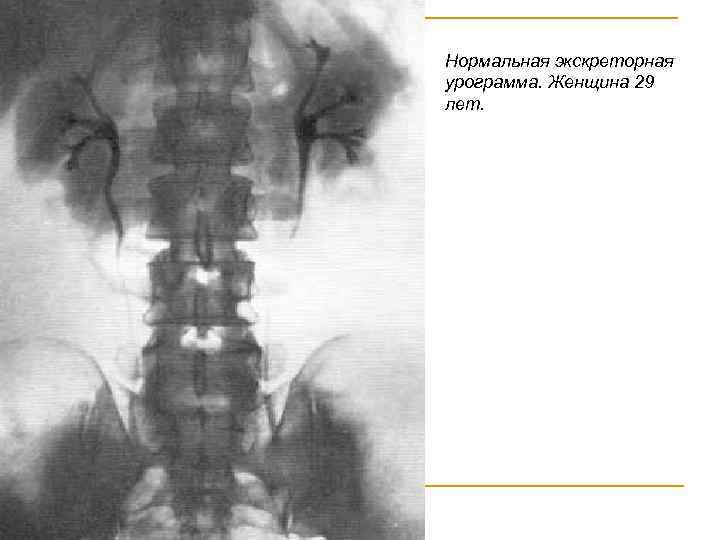 Нормальная экскреторная урограмма. Женщина 29 лет. 