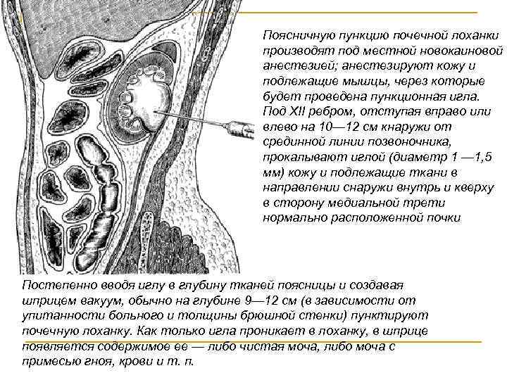 Поясничную пункцию почечной лоханки производят под местной новокаиновой анестезией; анестезируют кожу и подлежащие мышцы,