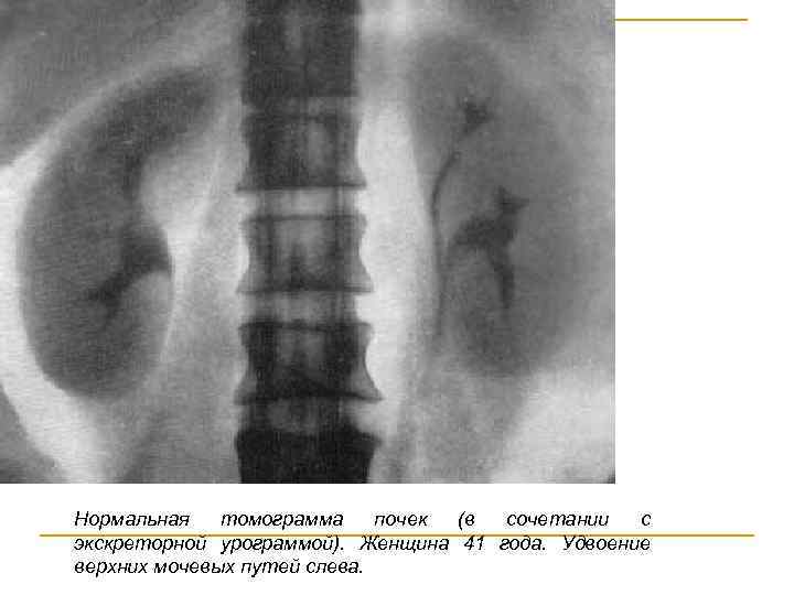 Нормальная томограмма почек (в сочетании с экскреторной урограммой). Женщина 41 года. Удвоение верхних мочевых