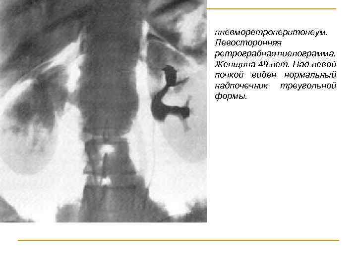 пневморетроперитонеум. Левосторонняя ретроградная пиелограмма. Женщина 49 лет. Над левой почкой виден нормальный надпочечник треугольной