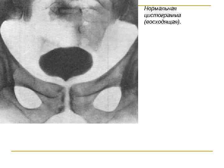 Нормальная цистограмма (восходящая). 