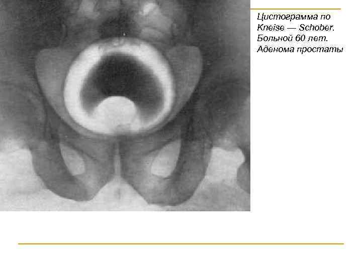 Цистограмма по Kneise — Schober. Больной 60 лет. Аденома простаты 