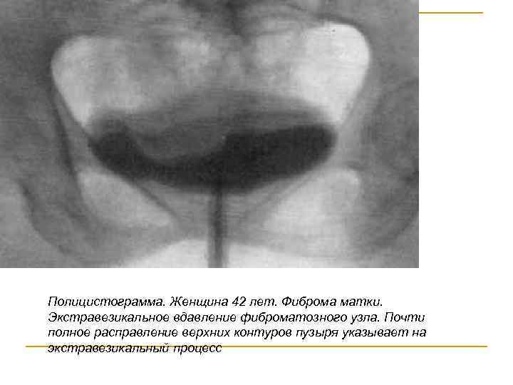 Полицистограмма. Женщина 42 лет. Фиброма матки. Экстравезикальное вдавление фиброматозного узла. Почти полное расправление верхних