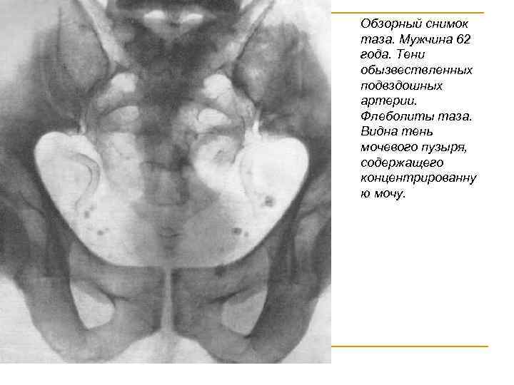 Обзорный снимок таза. Мужчина 62 года. Тени обызвествленных подвздошных артерии. Флеболиты таза. Видна тень