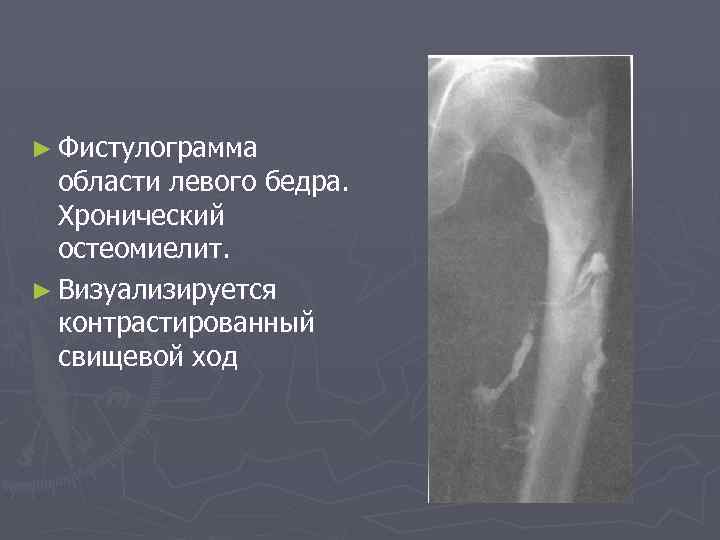 ► Фистулограмма области левого бедра. Хронический остеомиелит. ► Визуализируется контрастированный свищевой ход 