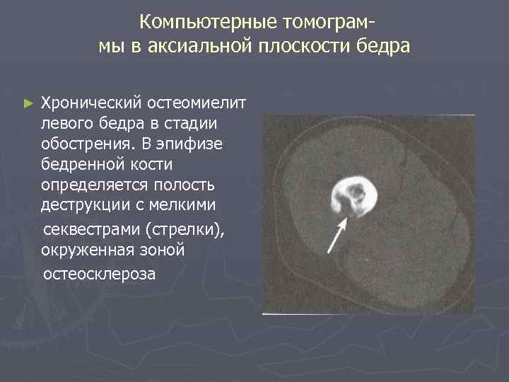 Компьютерные томограммы в аксиальной плоскости бедра ► Хронический остеомиелит левого бедра в стадии обострения.