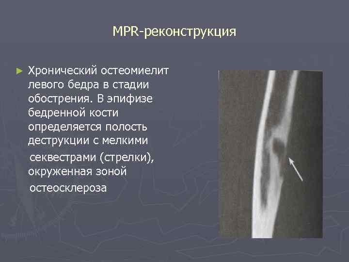 Кт картина краевой деструкции смежных костей наиболее характерна для