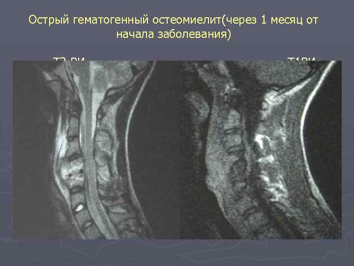 Острый гематогенный остеомиелит(через 1 месяц от начала заболевания) Т 2 ВИ Т 1 ВИ