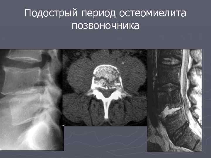 Подострый период остеомиелита позвоночника 