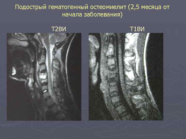 Подострый гематогенный остеомиелит (2, 5 месяца от начала заболевания) Т 2 ВИ Т 1