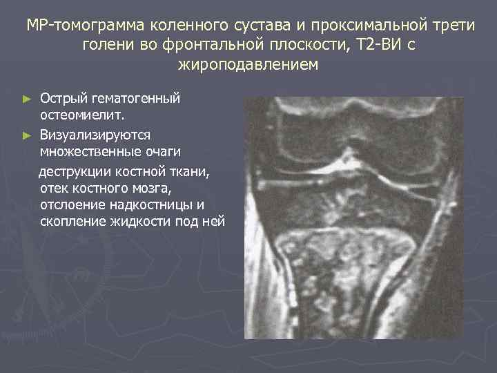 МР-томограмма коленного сустава и проксимальной трети голени во фронтальной плоскости, Т 2 -ВИ с