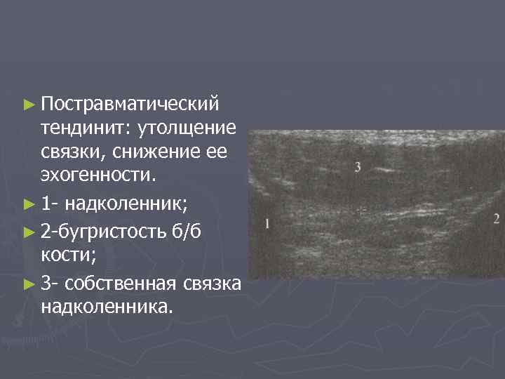 ► Постравматический тендинит: утолщение связки, снижение ее эхогенности. ► 1 - надколенник; ► 2