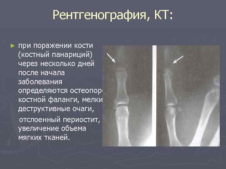 Рентгенография, КТ: ► при поражении кости (костный панариций) через несколько дней после начала заболевания