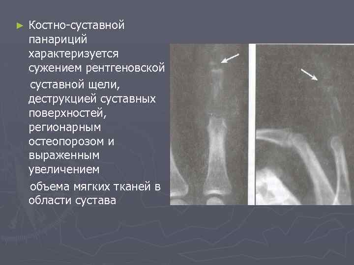 ► Костно-суставной панариций характеризуется сужением рентгеновской суставной щели, деструкцией суставных поверхностей, регионарным остеопорозом и