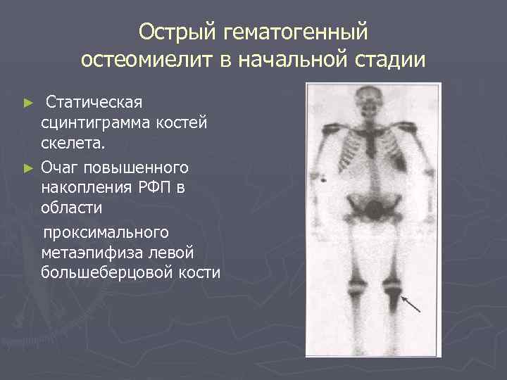 Поражение костей скелета