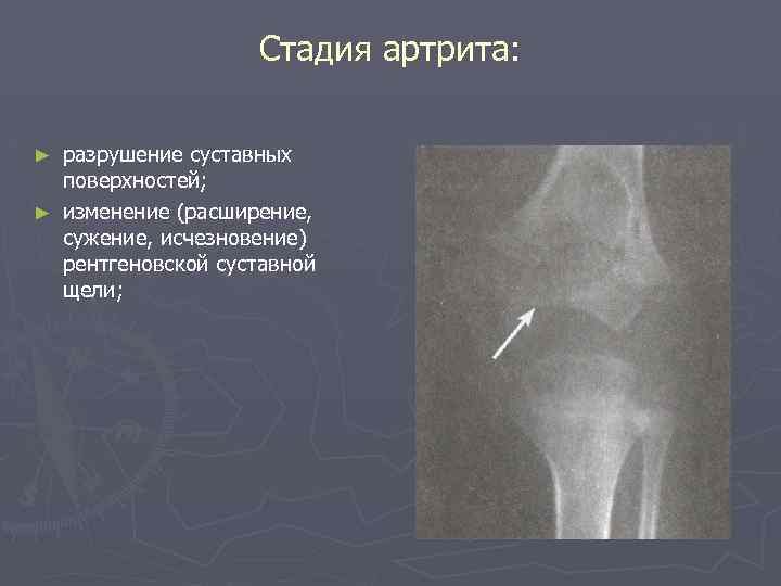 Расширение сужение. Деструкция суставных поверхностей. Деструкция суставных поверхностей костей. Сужение рентгеновской суставной щели. Десструкция с уставной. Поверхности сустава.