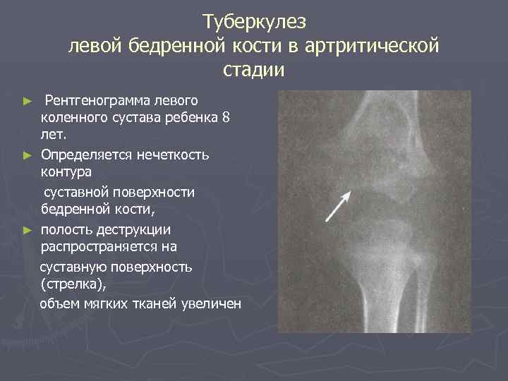 Туберкулез левой бедренной кости в артритической стадии Рентгенограмма левого коленного сустава ребенка 8 лет.