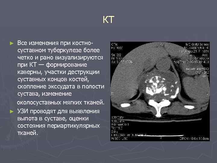 КТ Все изменения при костносуставном туберкулезе более четко и рано визуализируются при КТ —